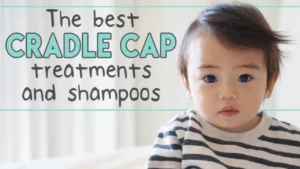 Best Cradle Cap Treatments